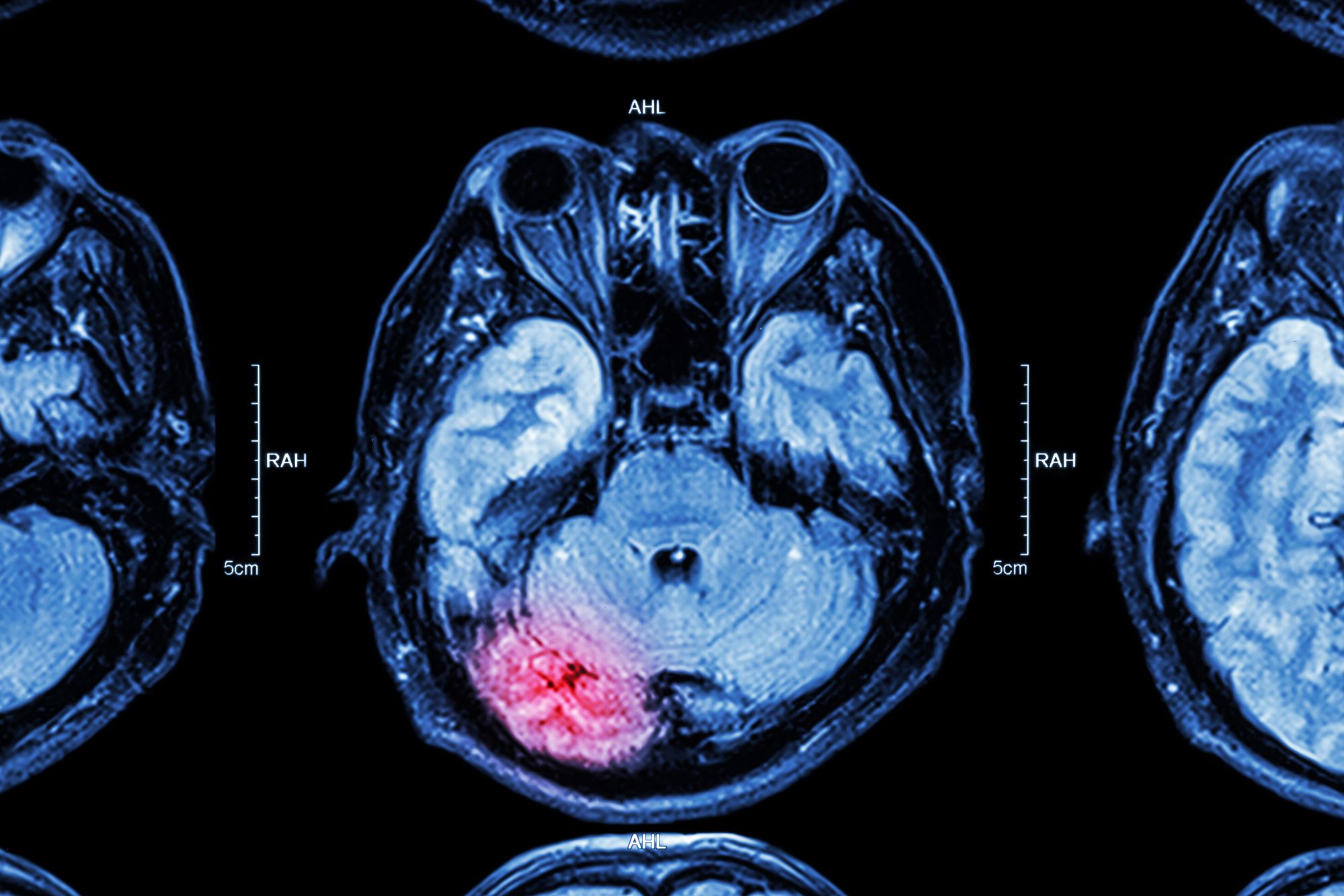 MRI of a brain injury
