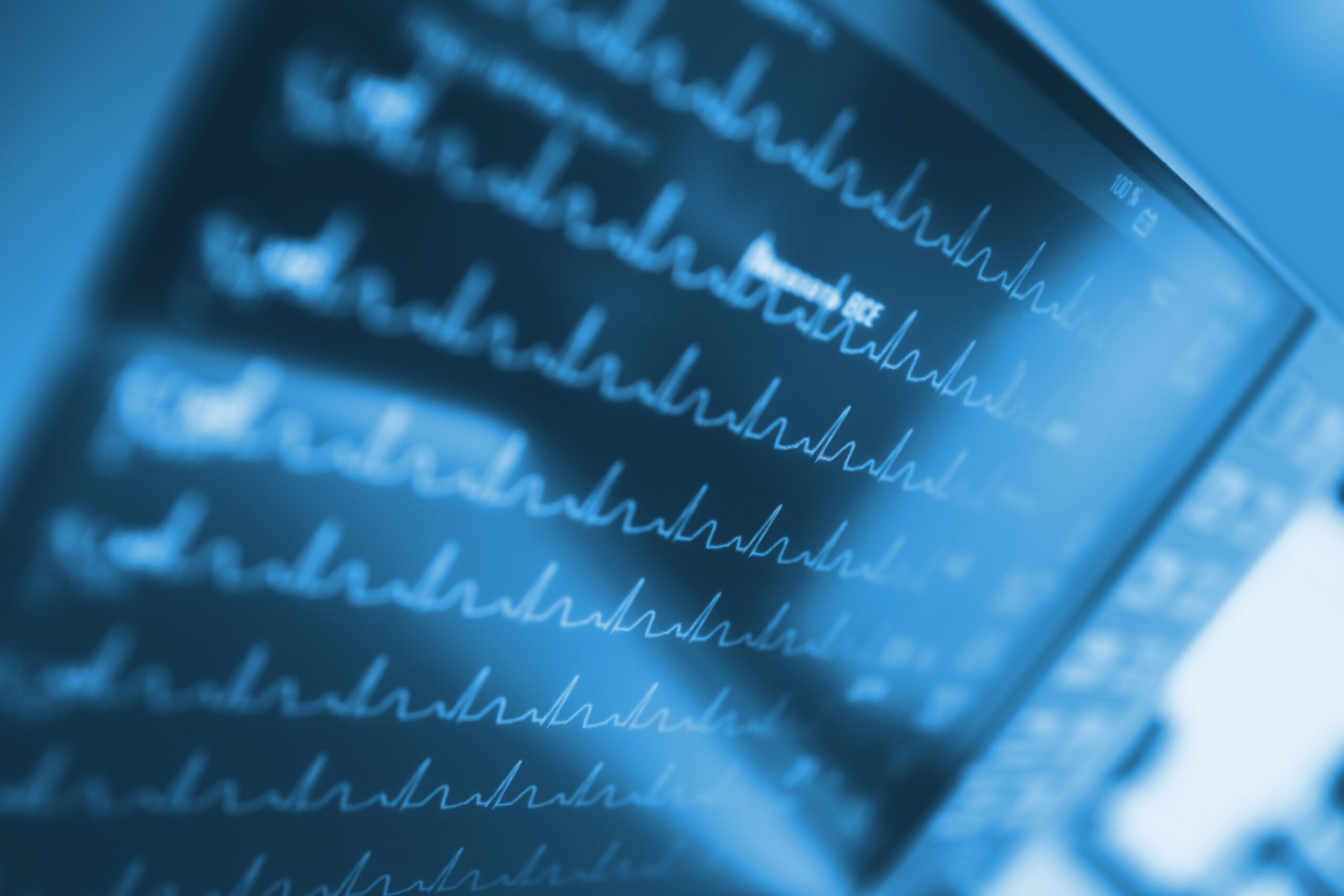 Close-up of a medical monitor screen displaying multiple EKG heart rhythm waveforms