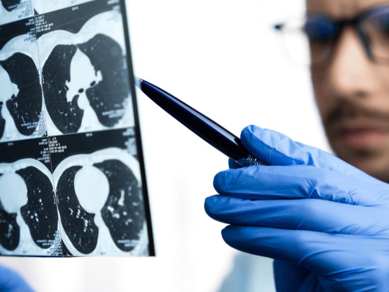 Doctor looking at x-ray with latex glove on