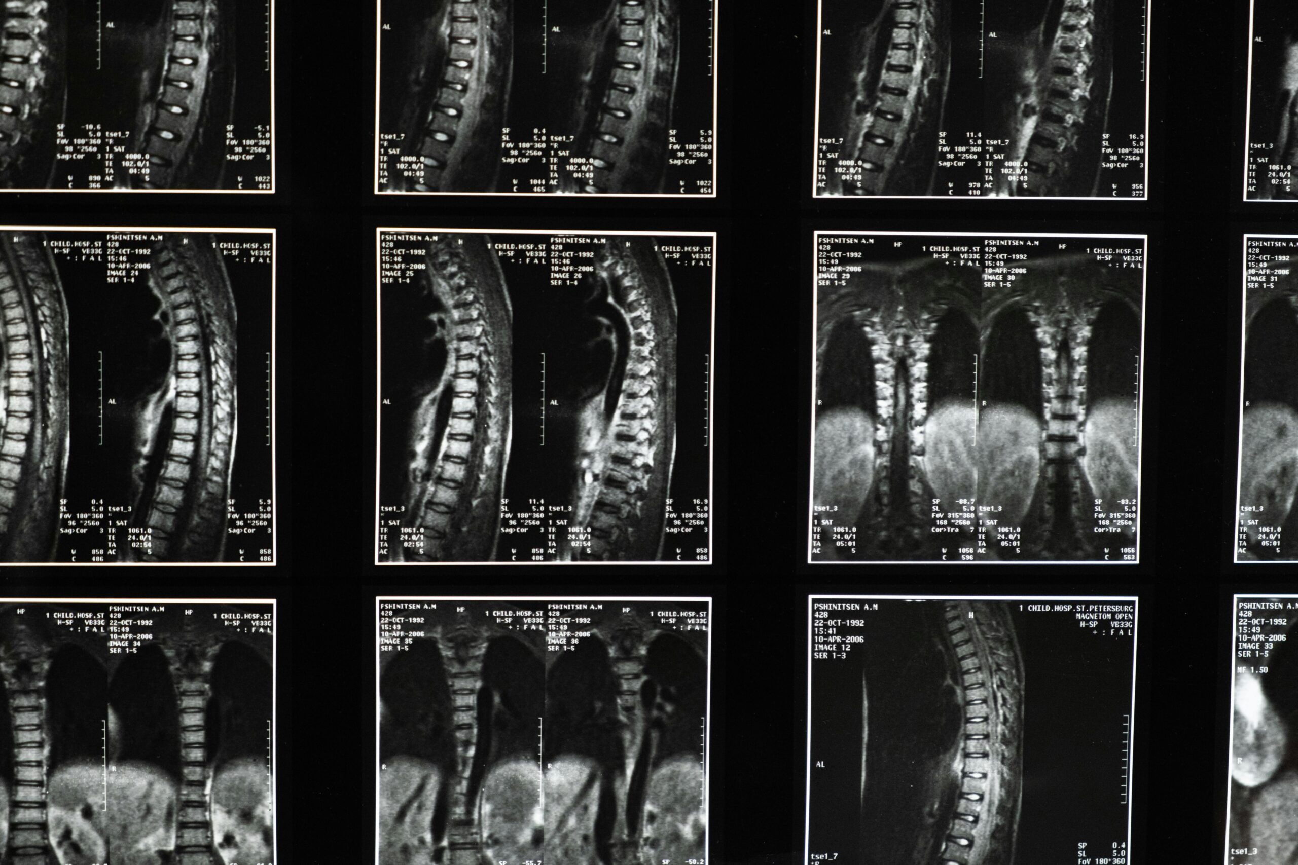 Multiple X-ray images showcasing the spine from different angles for diagnostic purposes