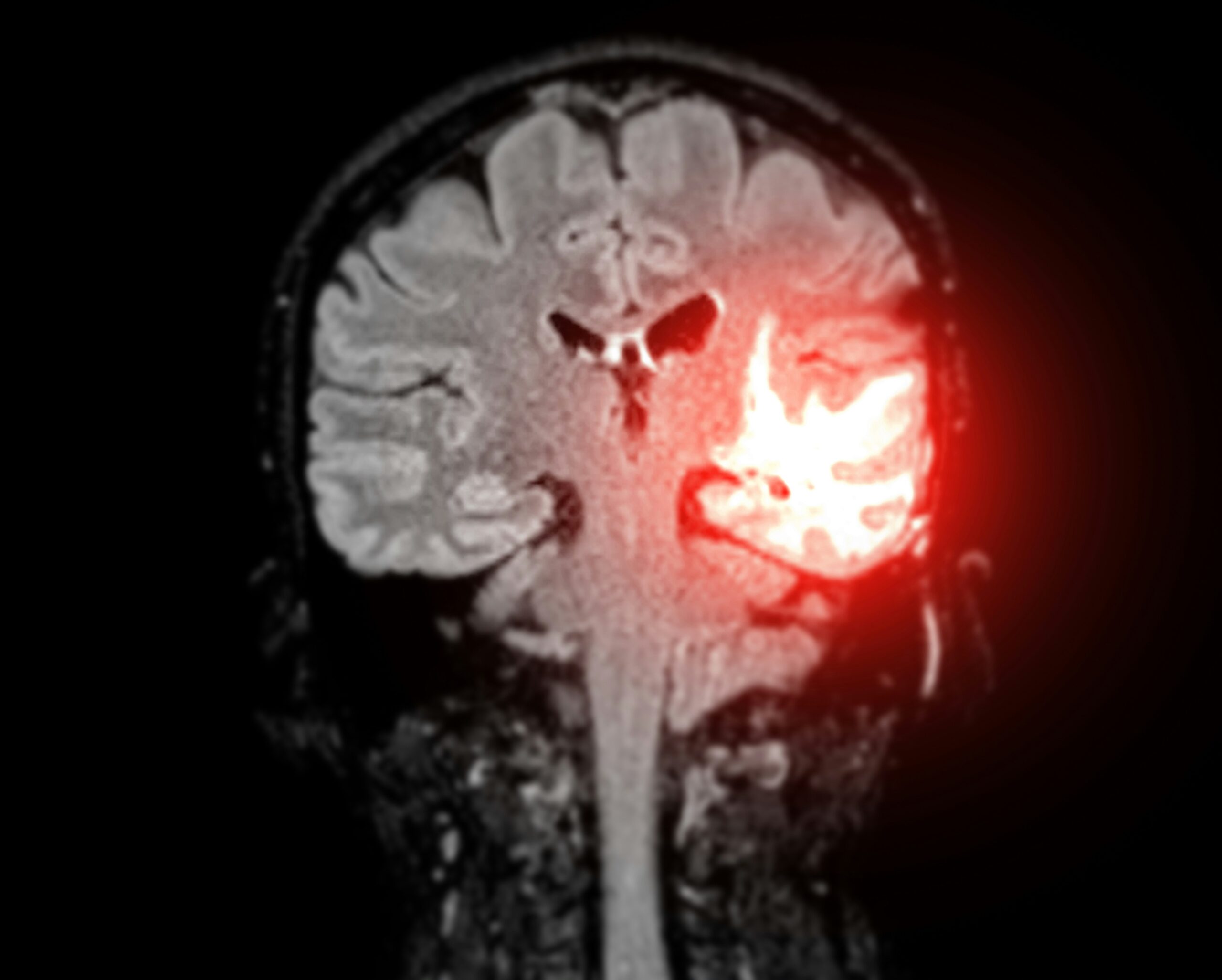 a brain scan all lit up on one side